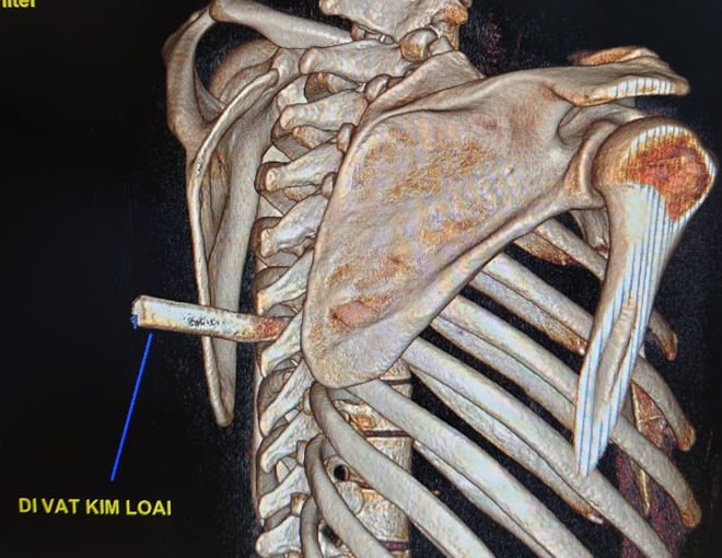 Mang cả mũi dao đâm vào cột sống đến bệnh viện - Ảnh 2.