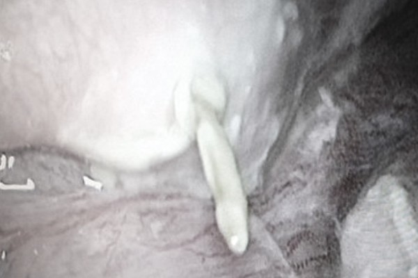 Nghệ An: Phẫu thuật thành công 2 cháu bé bị thủng ruột do nuốt tăm - Ảnh 1.