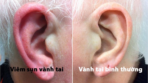 Mưng mủ vì bấm lỗ tai không bảo đảm vô trùng - Ảnh 1.