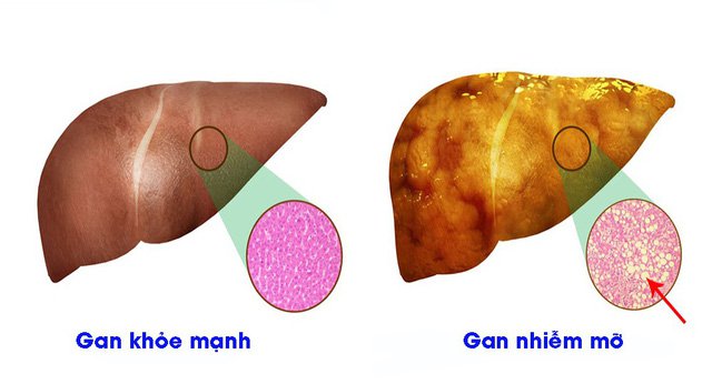 4 dấu hiệu nhận biết tổn thương gan nhiễm mỡ - Ảnh 1.