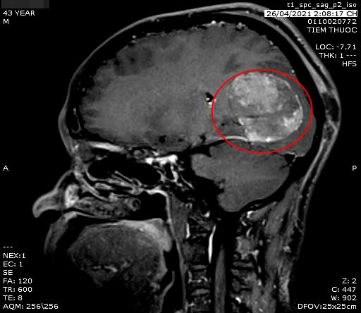 Phát hiện u não qua 1 cú ngã - Ảnh 1.