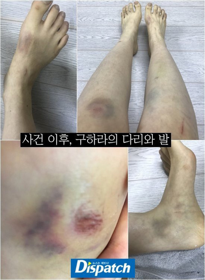 Mỹ nhân Hàn bị bạo hành: Mỹ nhân Hậu Duệ Mặt Trời - Goo Hara bị đánh dã man, rùng mình Choi Jin Sil tự tử liên hoàn và sao nữ sảy thai - Ảnh 12.