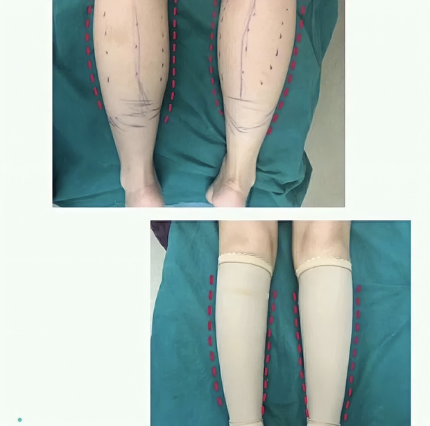 Đôi chân trong truyện tranh: Trào lưu phẫu thuật thẩm mỹ cắt bỏ dây thần kinh để sở hữu bắp chân thon gọn của các cô nàng Trung Quốc - Ảnh 1.