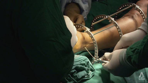 Đập xương kéo chân: Phương pháp phẫu thuật thẩm mỹ kinh dị đột nhiên thành “hot trend” ở Ấn Độ và hậu quả kinh hoàng phía sau - Ảnh 1.