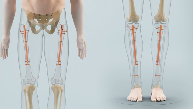 Đập xương kéo chân: Phương pháp phẫu thuật thẩm mỹ kinh dị đột nhiên thành “hot trend” ở Ấn Độ và hậu quả kinh hoàng phía sau - Ảnh 2.