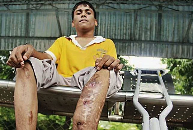 Đập xương kéo chân: Phương pháp phẫu thuật thẩm mỹ kinh dị đột nhiên thành “hot trend” ở Ấn Độ và hậu quả kinh hoàng phía sau - Ảnh 7.