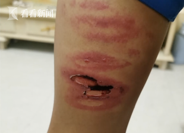 Học sinh lớp 8 bị giáo viên đánh bầm dập, không dám hé răng vì sợ bị trừng trị - Ảnh 2. Học sinh lớp 8 bị giáo viên đánh bầm dập, không dám hé răng vì sợ bị trừng trị - Ảnh 2.