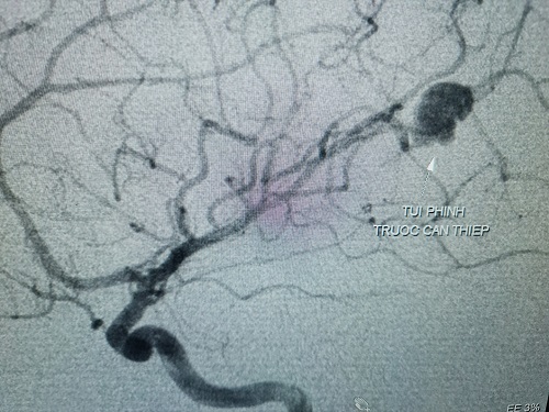 45 phút cứu sống bệnh nhi vỡ túi phình mạch máu não - Ảnh 1.