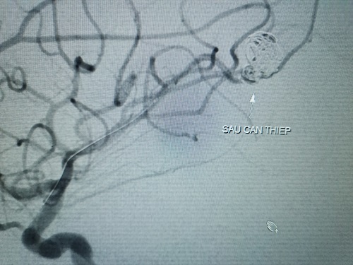 45 phút cứu sống bệnh nhi vỡ túi phình mạch máu não - Ảnh 2.