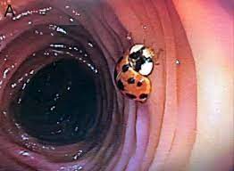 Kiểm tra đường ruột bệnh nhân, bác sĩ không tin nổi vào mắt mình khi thấy 1 thứ đang bò lổm ngổm bên trong - Ảnh 2.