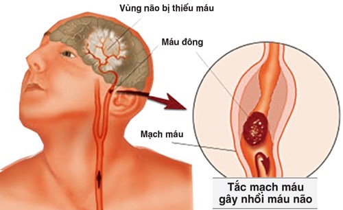 Bệnh thiểu năng tuần hoàn não ngày càng trẻ hóa, cách nào phát hiện sớm - Ảnh 1.