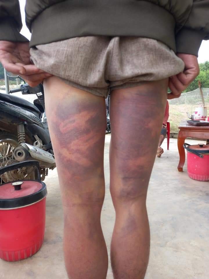 Người đàn ông tố bị đánh đập bầm tím 2 chân ở trụ sở xã - Ảnh 1.