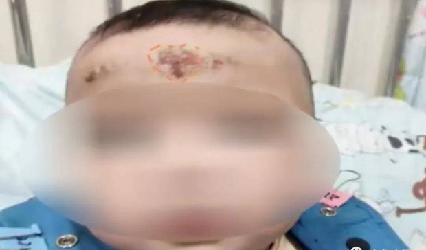 Bé gái 10 tháng tuổi xuất hiện dấu hiệu lạ trên trán, mẹ hốt hoảng đưa con đến bệnh viện rồi ngã ngửa vì cách chữa bệnh theo kiểu bà ngoại - Ảnh 3.