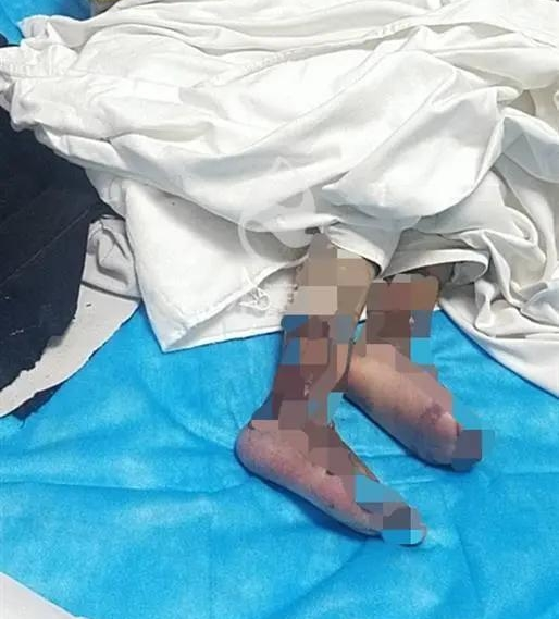Bị mẹ kế bạo hành 20 ngày, cô bé 4 tuổi cấp cứu vì suy đa tạng, nguy cơ bị cắt cụt 2 chân - Ảnh 5. Bị mẹ kế bạo hành 20 ngày, cô bé 4 tuổi cấp cứu vì suy đa tạng, nguy cơ bị cắt cụt 2 chân - Ảnh 5.