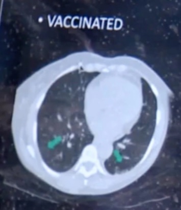 So ảnh X-quang của người đã tiêm và chưa tiêm vaccine Covid-19, rút ra kết luận kinh ngạc - Ảnh 1.