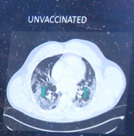 So ảnh X-quang của người đã tiêm và chưa tiêm vaccine Covid-19, rút ra kết luận kinh ngạc - Ảnh 2.