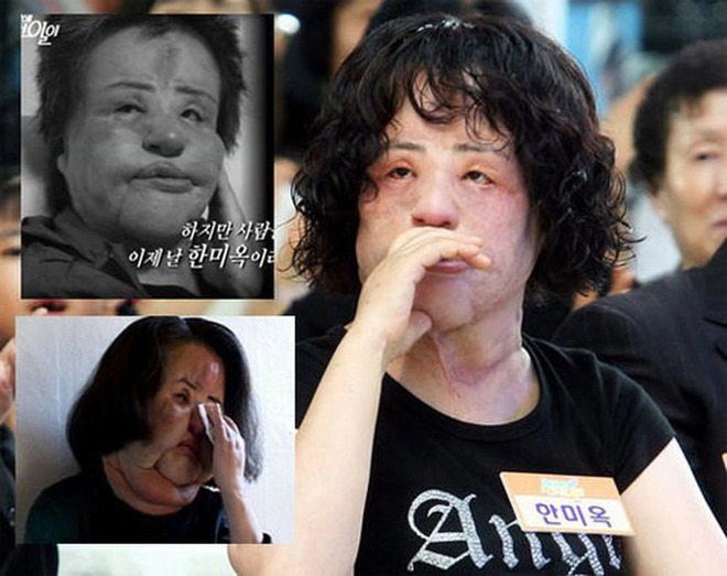 Thảm họa thẩm mỹ xứ Hàn: Nữ ca sĩ 17 lần phẫu thuật cứu vãn nhan sắc vì tự tiêm dầu ăn và cái chết bí ẩn tuổi 57  - Ảnh 7.