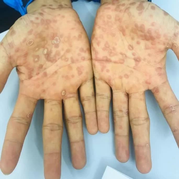 Bác sĩ Đoàn Văn Lợi Em cảnh báo nóng về giang mai - Ảnh 1.