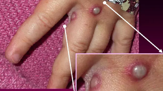 Ca mắc đậu mùa khỉ đầu tiên tại Việt Nam được phát hiện như thế nào? - Ảnh 2. Ca mắc đậu mùa khỉ đầu tiên tại Việt Nam được phát hiện như thế nào? - Ảnh 2.