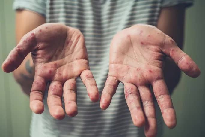 Ca mắc đậu mùa khỉ đầu tiên tại Việt Nam được phát hiện như thế nào? - Ảnh 1. Ca mắc đậu mùa khỉ đầu tiên tại Việt Nam được phát hiện như thế nào? - Ảnh 1.