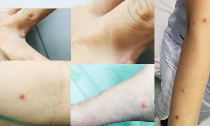 Vết mụn nước ở ca mắc đậu mùa khỉ tại Việt Nam có nguy hiểm? Chuyên gia người Việt tại Đức lý giải - Ảnh 1. Vết mụn nước ở ca mắc đậu mùa khỉ tại Việt Nam có nguy hiểm? Chuyên gia người Việt tại Đức lý giải - Ảnh 1.