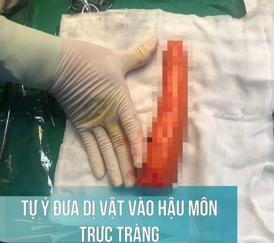 Thử cảm giác lạ, nam thanh niên tự nhét củ cà rốt 20 cm vào hậu môn - Ảnh 1.