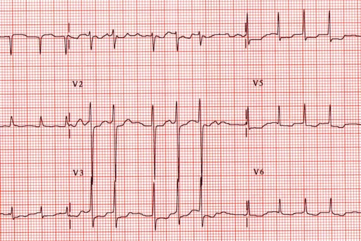 Quá trình lão hóa khiến nguy cơ mắc bệnh tim tăng lên? - Ảnh 5.