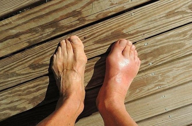 Những dấu hiệu khác thường trên bàn chân cho thấy sức khỏe của bạn đang ‘kêu cứu’ - Ảnh 2.