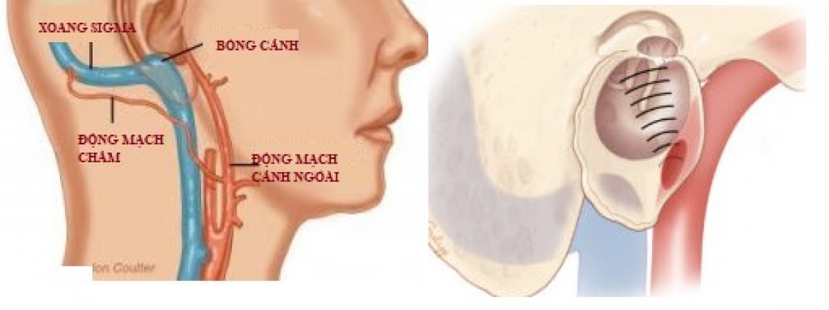 Ù tai có thể là chỉ dấu báo trước về bệnh tim mạch nguy hiểm - Ảnh 1.