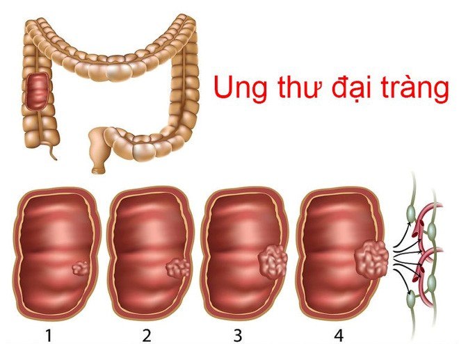 Ung thư ruột kết mà vua bóng đá Pele mắc nguy hiểm thế nào, cách phát hiện và phòng ngừa? - Ảnh 2.