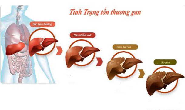 6 cách giúp phục hồi và giữ cho gan khỏe mạnh - Ảnh 2.