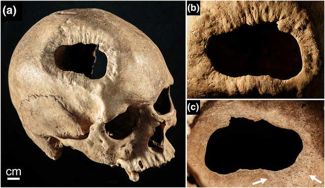 2000 năm trước ở Peru, người cổ đại đã có thể mổ hộp sọ mà không cần dùng thuốc mê hay kháng sinh - Ảnh 6.