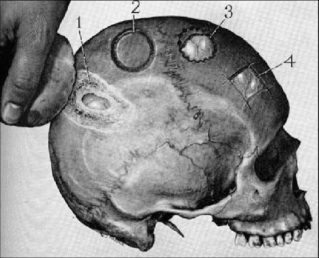 2000 năm trước ở Peru, người cổ đại đã có thể mổ hộp sọ mà không cần dùng thuốc mê hay kháng sinh - Ảnh 12.