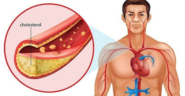 9 thực phẩm kiểm soát cholesterol và giảm nguy cơ mắc bệnh tim - Ảnh 1.