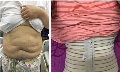 Hình ảnh khác lạ của nàng béo “ai cũng biết”: Sau 4 năm mất 8 lít mỡ bụng, giảm 60 kg - Ảnh 2.