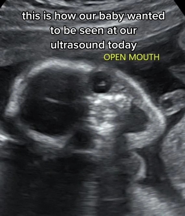 Bức ảnh siêu âm em bé kì dị thu hút 9 triệu lượt xem nhưng sự thật được người mẹ tiết lộ khiến ai cũng ấm lòng - Ảnh 3.