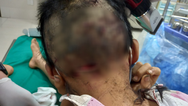 Bé trai 10 tuổi hoảng loạn vì bị chó cắn, vết thương chằng chịt vùng đầu, tay, chân - Ảnh 1.