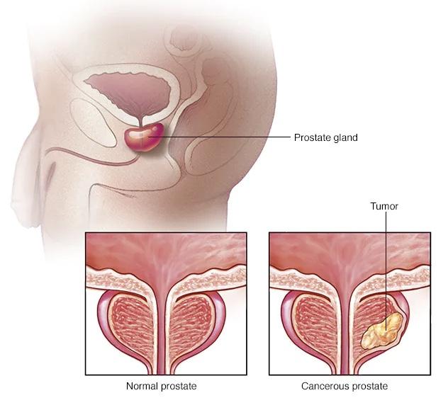 Nước tiểu có dấu hiệu này có thể cảnh báo ung thư, nam giới đừng chủ quan! - Ảnh 1.