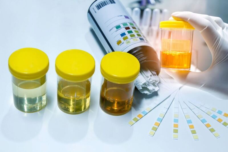 Từ xét nghiệm nước tiểu có thể phát hiện nhiều bệnh cực kỳ nguy hiểm - Ảnh 1.