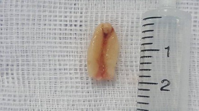 Bé 5 tuổi tử vong do hóc hạt lạc: Bác sĩ cảnh báo điều đơn giản ai cũng cần phải biết - Ảnh 1. Bé 5 tuổi tử vong do hóc hạt lạc: Bác sĩ cảnh báo điều đơn giản ai cũng cần phải biết - Ảnh 1.