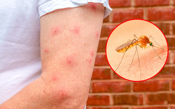 Mách bạn 9 cách trị vết muỗi đốt làm dịu cảm giác khó chịu ngay tức thì - Ảnh 1.
