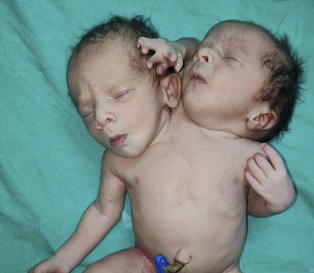 The mother excitedly thought that she was having twins, the baby was born, making both mothers and doctors panic - Photo 2.
