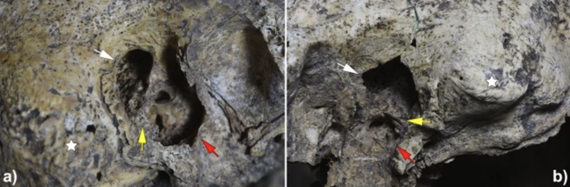 Hộp sọ cổ đại cho thấy bằng chứng về ca phẫu thuật tai đầu tiên của loài người - Ảnh 2.