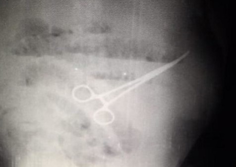 Bệnh nhân 59 tuổi bị bác sĩ phẫu thuật bỏ quên kéo trong bụng - Ảnh 2.