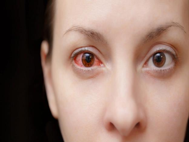 Cảnh báo 5 dấu hiệu nhiễm trùng mắt liên quan đến COVID-19 - Ảnh 1.