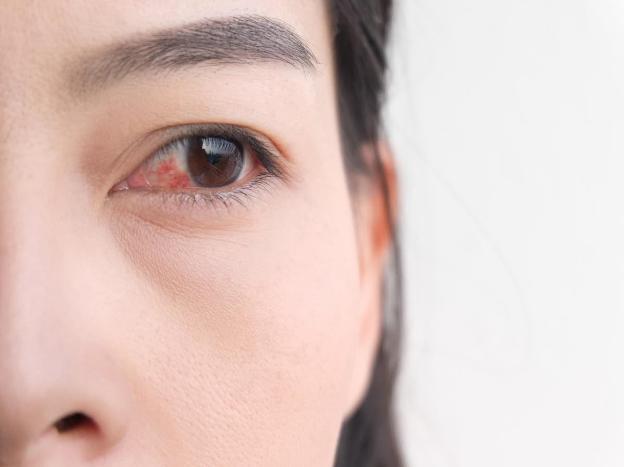 Cảnh báo 5 dấu hiệu nhiễm trùng mắt liên quan đến COVID-19 - Ảnh 4.