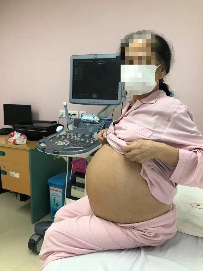 Người phụ nữ bụng to như mang thai 9 tháng  ở tuổi 71 - Ảnh 1.