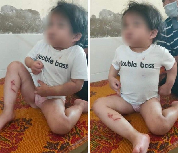 Hà Tĩnh: Bé gái 4 tuổi nhập viện nghi bị bạo hành - Ảnh 1.