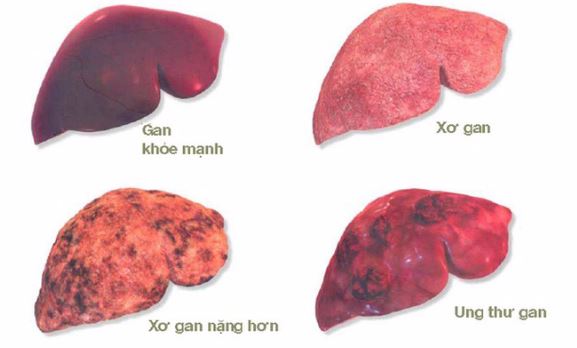 Xơ gan: Những điều cần làm ngay để phòng tránh biến chứng - Ảnh 1.