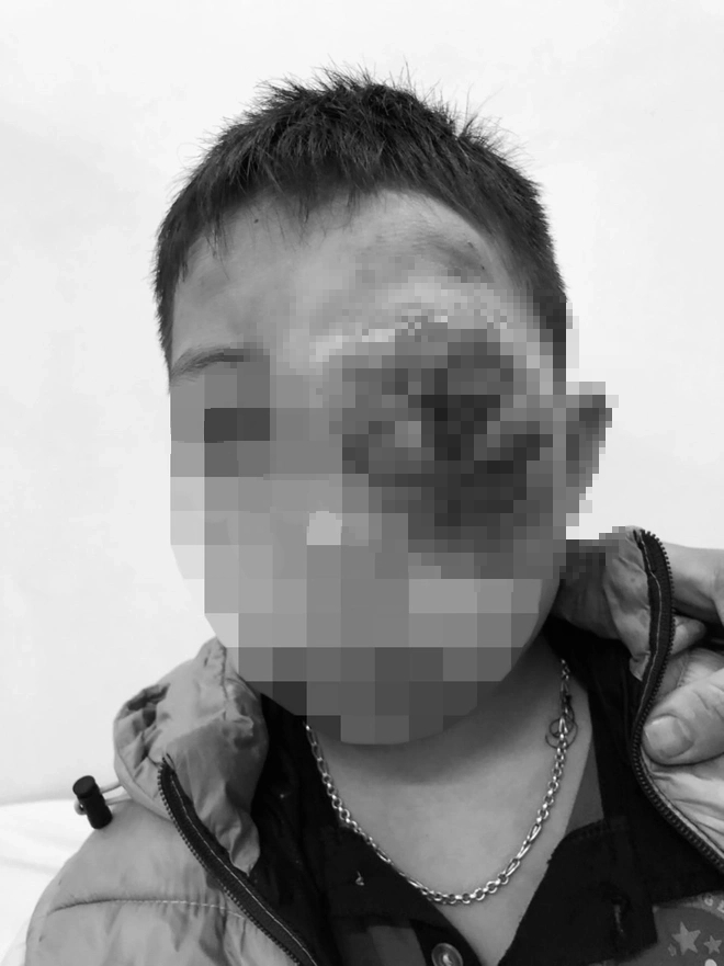 Cậu bé dân tộc Thái mang khối u trên mắt suốt 9 năm khiến mặt biến dạng - Ảnh 1.